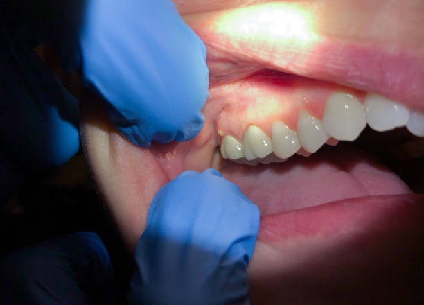 Best Emergency Wisdom Teeth Removal in Melrose Park, NY